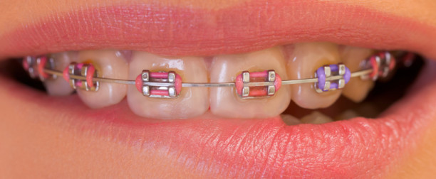 Dr-Frost-colored-braces1-612x252.jpg