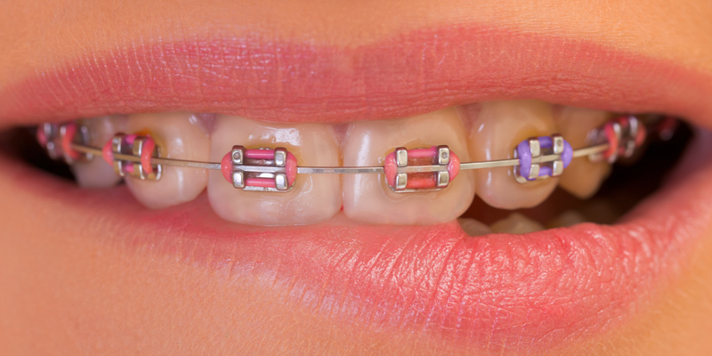 Dr Frost colored braces1