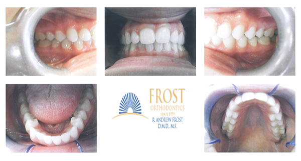 Frost-Case-Study-Brittany-After
