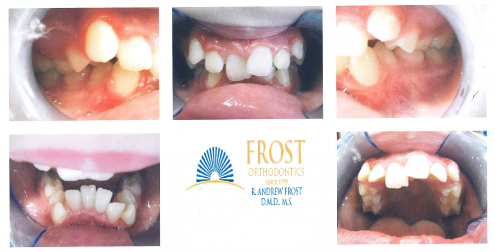 Case Study: Lee Anna (Braces) | Frost Orthodontics - Braces St. Louis