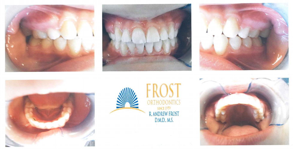 Case Study: Sarah (Braces) | Frost Orthodontics - Braces in St. Louis