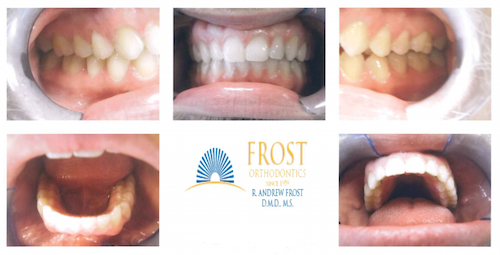 Case Study: Adult Invisalign St. Louis | Frost Orthodontics