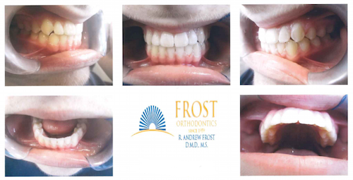 Braces Archives | Frost Orthodontics Case Studies | St. Louis Orthodontist
