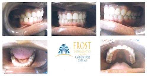 Case Study: Alicia (Adult Braces) | Frost Orthodontics in St. Louis