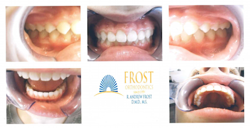 Braces Archives | Frost St. Louis Orthodontist