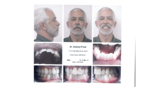 Frost Orthodontics of St. Louis - Case Study: Mark (Adult Invisalign) Before Photo