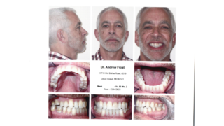 Frost Orthodontics of St. Louis - Case Study: Mark (Adult Invisalign) - After Photo