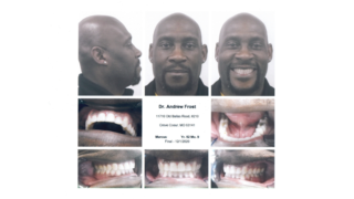 Frost Orthodontics - Case Study: Marcus (Adult Braces) After