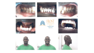 Frost Orthodontics - Case Suty: Marcus (Adult Braces) Before